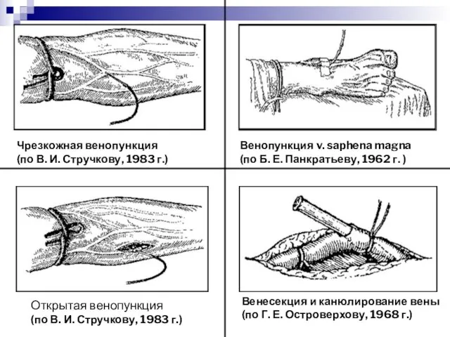 Чрезкожная венопункция (по В. И. Стручкову, 1983 г.) Венопункция v. saphena