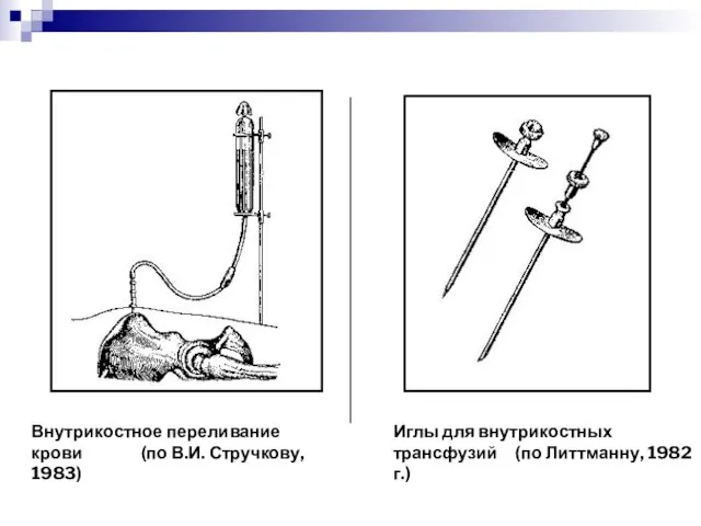 Внутрикостное переливание крови (по В.И. Стручкову, 1983) Иглы для внутрикостных трансфузий (по Литтманну, 1982 г.)