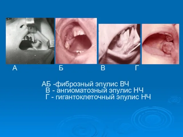 АБ -фиброзный эпулис ВЧ В - ангиоматозный эпулис НЧ Г -