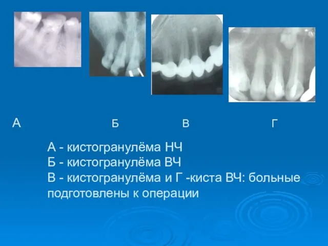 А - кистогранулёма НЧ Б - кистогранулёма ВЧ В - кистогранулёма