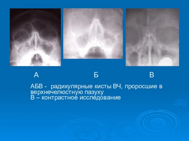 АБВ - радикулярные кисты ВЧ, проросшие в верхнечелюстную пазуху В – контрастное исследование А Б В