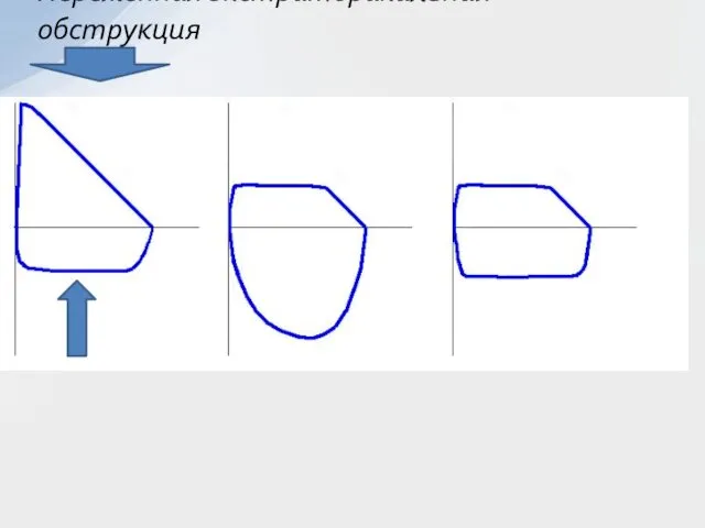 Переменная экстраторакальная обструкция