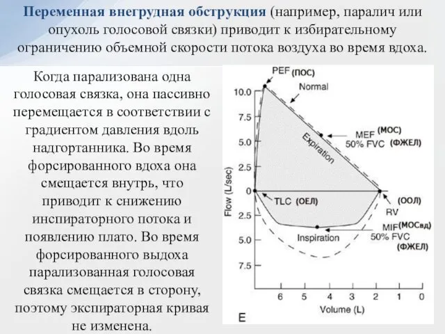 Переменная внегрудная обструкция (например, паралич или опухоль голосовой связки) приводит к