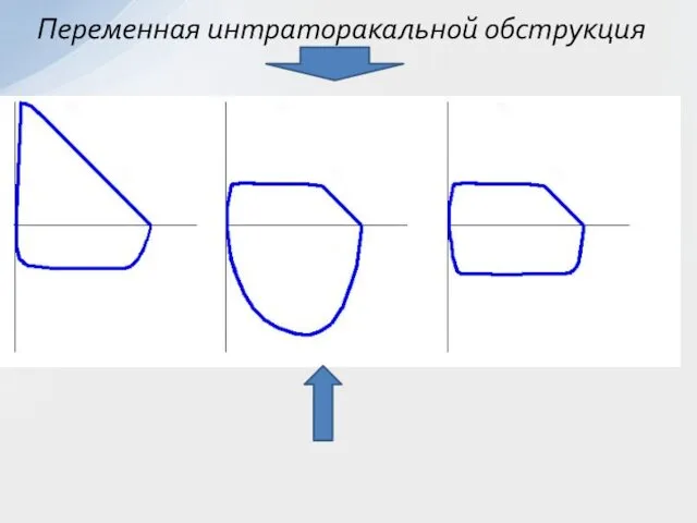 Переменная интраторакальной обструкция