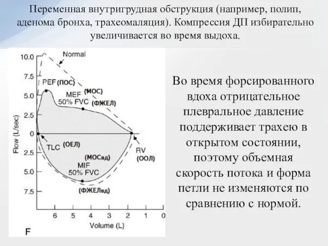 Переменная внутригрудная обструкция (например, полип, аденома бронха, трахеомаляция). Компрессия ДП избирательно