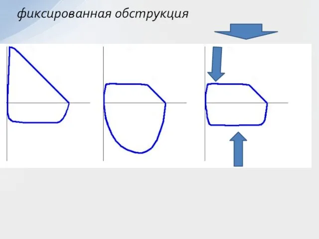 фиксированная обструкция