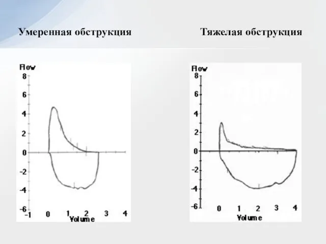 Умеренная обструкция Тяжелая обструкция