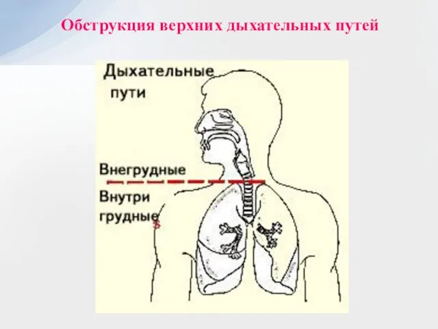 Обструкция верхних дыхательных путей