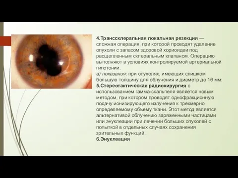 4.Транссклеральная локальная резекция — сложная операция, при которой проводят удаление опухоли