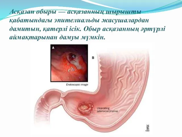 Асқазан обыры — асқазанның шырышты қабатындағы эпителиальды жасушалардан дамитын, қатерлі ісік.