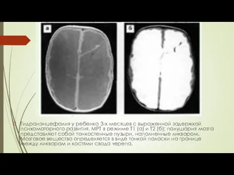 Гидранэнцефалия у ребенка 3-х месяцев с выраженной задержкой психомоторного развития. МРТ