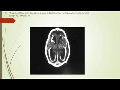 Микроцефалия. КТ головного мозга. Гипоплазия лобных долей, вторичная вентрикуломегалия.