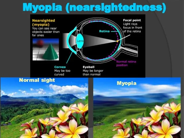 Normal sight Myopia Myopia (nearsightedness)