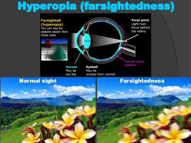 Normal sight Farsightedness Hyperopia (farsightedness)