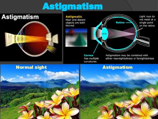 Normal sight Astigmatism Astigmatism