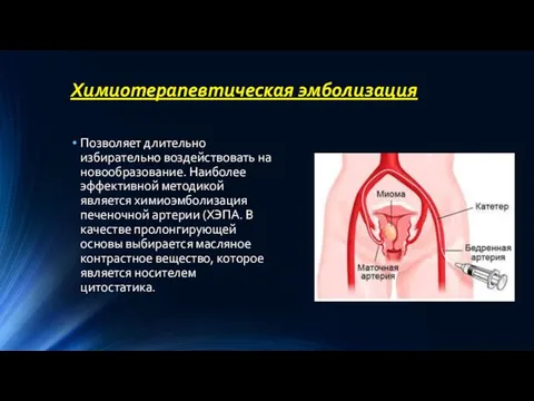 Химиотерапевтическая эмболизация Позволяет длительно избирательно воздействовать на новообразование. Наиболее эффективной методикой