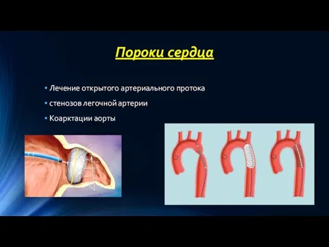 Пороки сердца Лечение открытого артериального протока стенозов легочной артерии Коарктации аорты