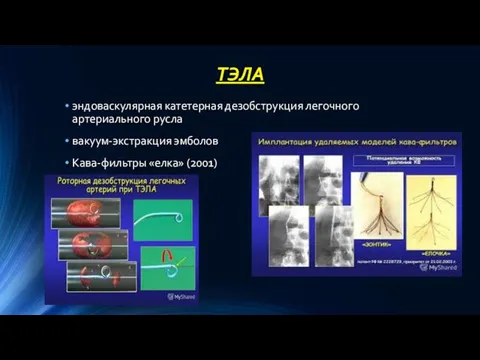 ТЭЛА эндоваскулярная катетерная дезобструкция легочного артериального русла вакуум-экстракция эмболов Кава-фильтры «елка» (2001)