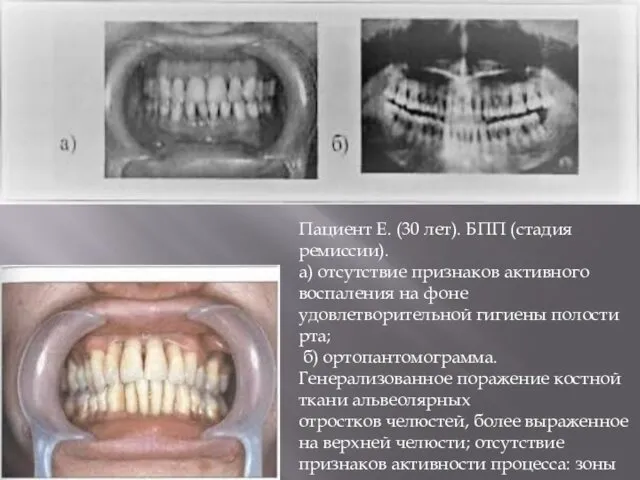 Пациент Е. (30 лет). БПП (стадия ремиссии). а) отсутствие признаков активного