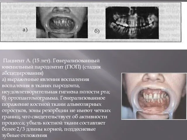 Пациент А. (15 лет). Генерализованный ювенильный пародонтит (ГЮП) (стадия абсцедирования) а)