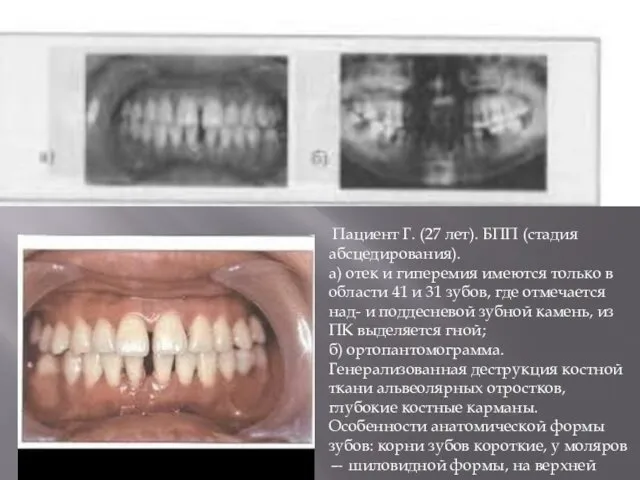 Пациент Г. (27 лет). БПП (стадия абсцедирования). а) отек и гиперемия