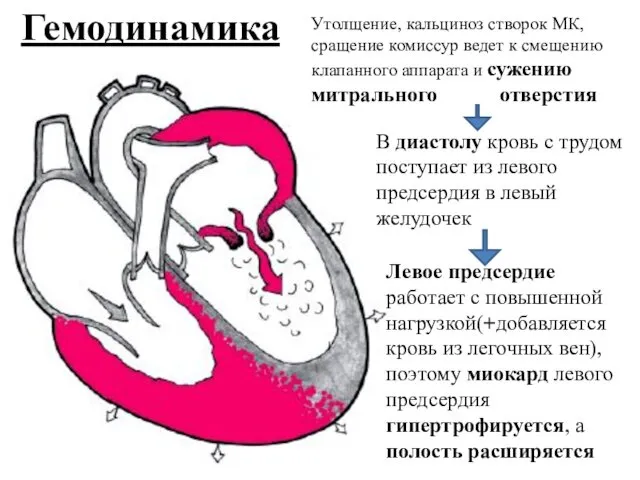 Гемодинамика Утолщение, кальциноз створок МК, сращение комиссур ведет к смещению клапанного