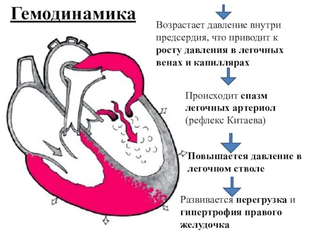 Гемодинамика Возрастает давление внутри предсердия, что приводит к росту давления в