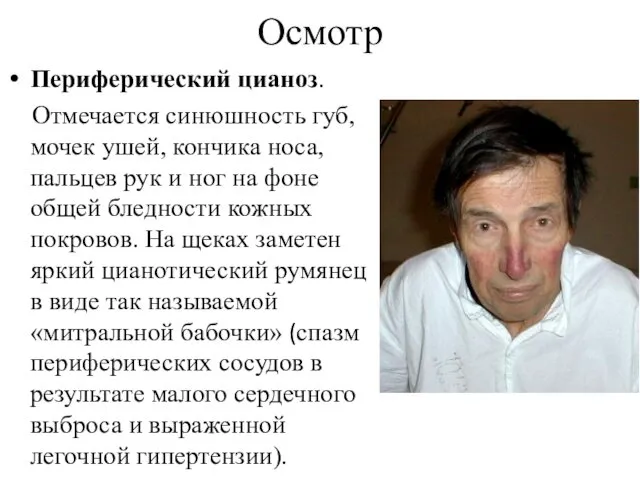 Осмотр Периферический цианоз. Отмечается синюшность губ, мочек ушей, кончика носа, пальцев