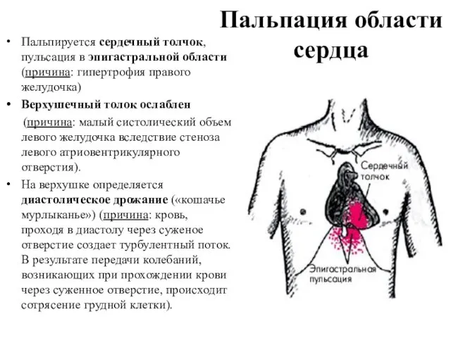 Пальпация области сердца Пальпируется сердечный толчок, пульсация в эпигастральной области (причина: