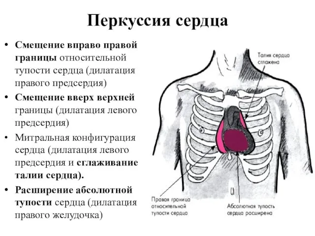 Перкуссия сердца Смещение вправо правой границы относительной тупости сердца (дилатация правого
