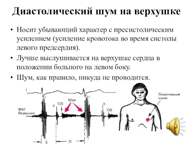 Диастолический шум на верхушке Носит убывающий характер с пресистолическим усилением (усиление