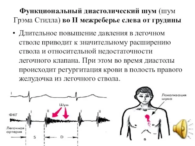 Функциональный диастолический шум (шум Грэма Стилла) во II межреберье слева от