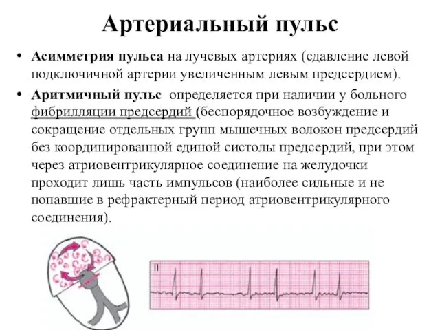 Артериальный пульс Асимметрия пульса на лучевых артериях (сдавление левой подключичной артерии