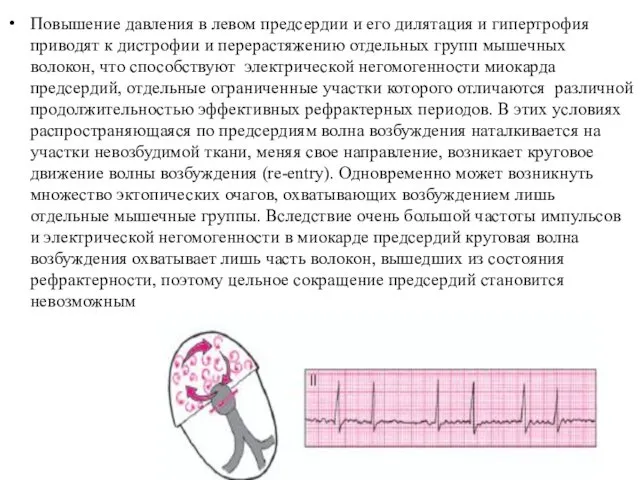 Повышение давления в левом предсердии и его дилятация и гипертрофия приводят