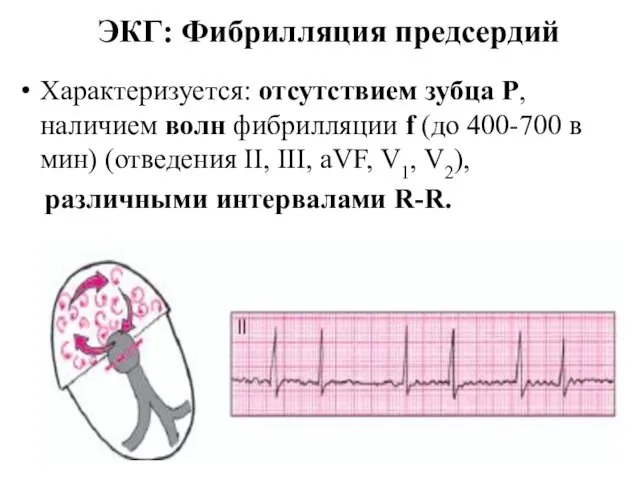 ЭКГ: Фибрилляция предсердий Характеризуется: отсутствием зубца Р, наличием волн фибрилляции f