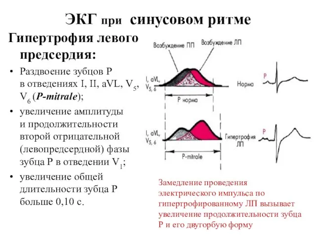 ЭКГ при синусовом ритме Гипертрофия левого предсердия: Раздвоение зубцов Р в