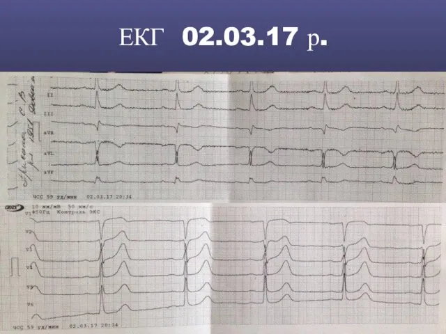 ЕКГ 02.03.17 р.