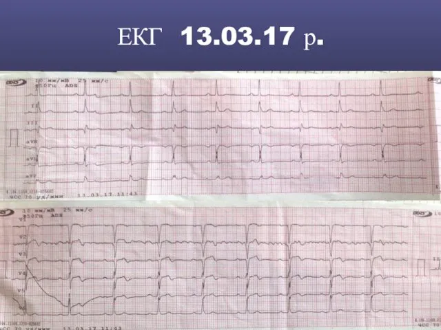 ЕКГ 13.03.17 р.