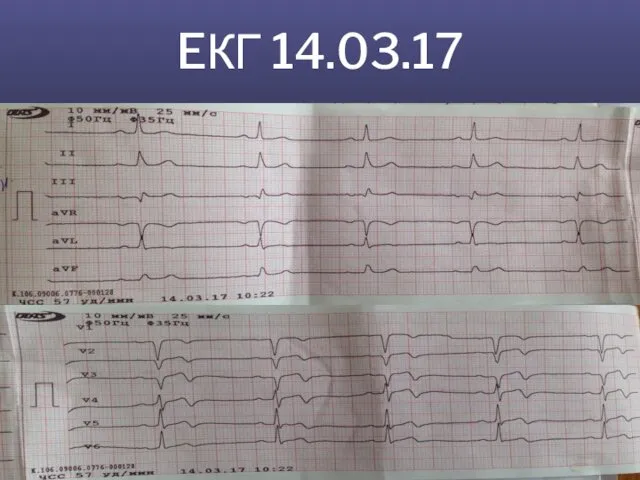 EКГ 14.03.17