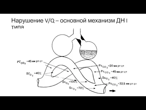 Нарушение V/Q – основной механизм ДН I типа