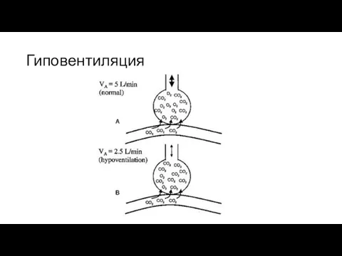 Гиповентиляция