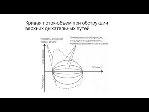 Кривая поток-объем при обструкции верхних дыхательных путей