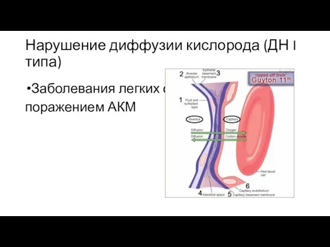 Нарушение диффузии кислорода (ДН I типа) Заболевания легких с поражением АКМ