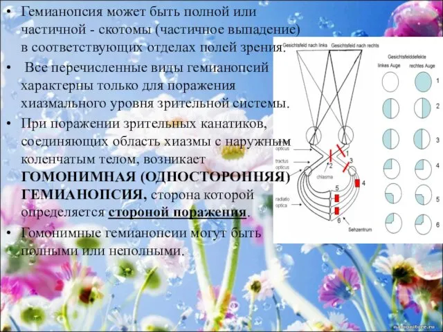 Гемианопсия может быть полной или частичной - скотомы (частичное выпадение) в