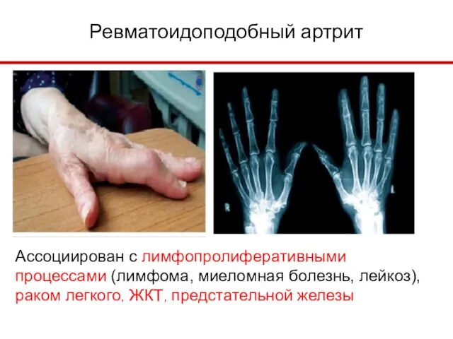 Ревматоидоподобный артрит Ассоциирован с лимфопролиферативными процессами (лимфома, миеломная болезнь, лейкоз), раком легкого, ЖКТ, предстательной железы.