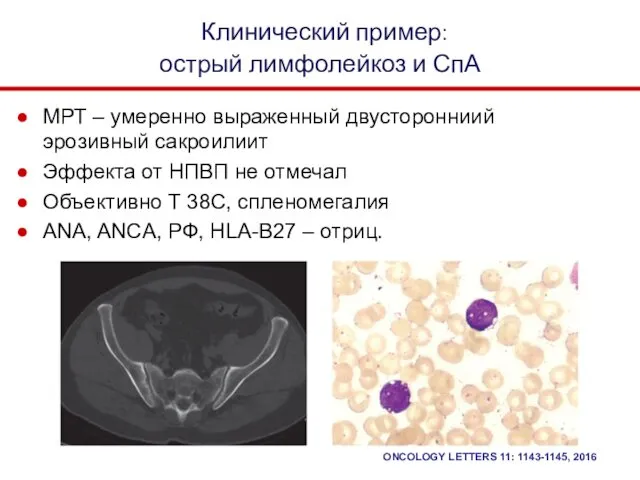 МРТ – умеренно выраженный двусторонниий эрозивный сакроилиит Эффекта от НПВП не