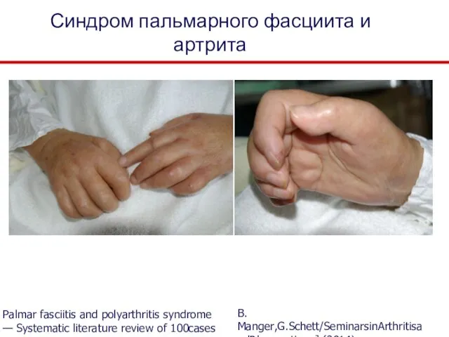 Синдром пальмарного фасциита и артрита B.Мanger,G.Schett/SeminarsinArthritisandRheumatism ] (2014) Palmar fasciitis and