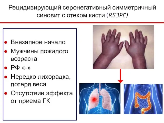 Рецидивирующий серонегативный симметричный синовит с отеком кисти (RS3PE) Внезапное начало Мужчины