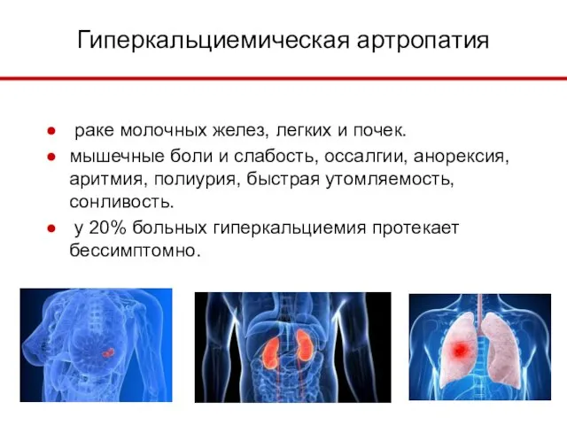 Гиперкальциемическая артропатия раке молочных желез, легких и почек. мышечные боли и