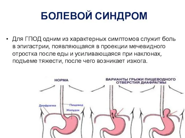 БОЛЕВОЙ СИНДРОМ Для ГПОД одним из характерных симптомов служит боль в